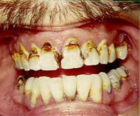 caries1.JPG